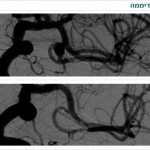 נוירוכירורג | מנתח מוח | ד"ר משה עטיה